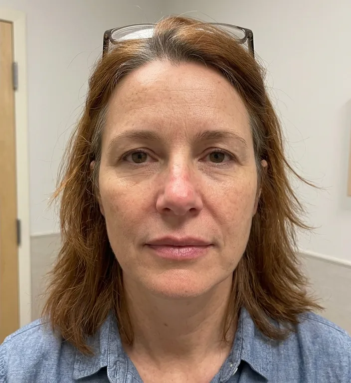 Ober- und Lippen nachher